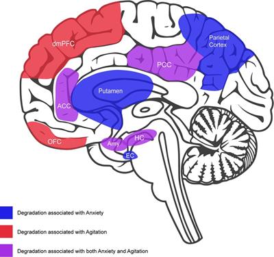 Developing a music-based digital therapeutic to help manage the neuropsychiatric symptoms of dementia